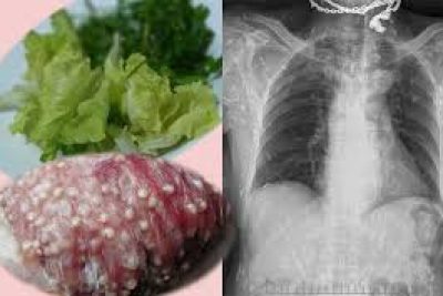 Biện pháp phòng tránh các bệnh về giun sán